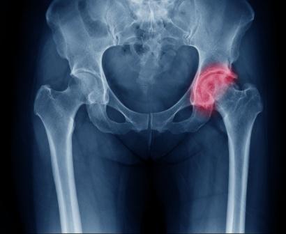 Почему кости пожилых людей подвержены переломам